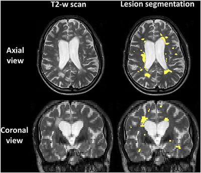 Comparison of Neurite Orientation Dispersion and Density Imaging and Two-Compartment Spherical Mean Technique Parameter Maps in Multiple Sclerosis